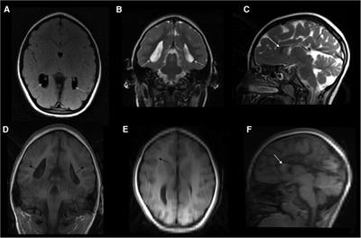 Case report: A gain-of-function of hamartin may lead to a distinct “inverse TSC1-hamartin” phenotype characterized by reduced cell growth